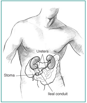 Anatomic drawing of male torso with ileal conduit urostomy and inner organs visible.  The small and large intestines are shown in outline.  The kidneys, ureters, and ileal conduit are displayed in more detail.  The ureters descend from the kidneys to the ileal conduit, which has been formed from a piece of the intestine.  One end of the conduit extends beyond the skin surface to form a stoma.
