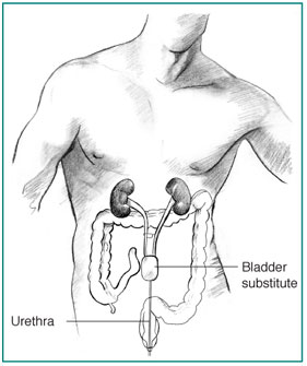 Anatomic drawing of male torso with bladder substitute and other inner organs visible.  The large intestine is shown in outline.  The kidneys, ureters, bladder substitute, and urethra are displayed in more detail.  The ureters descend from the kidneys to the bladder substitute, which is attached to the patient’s urethra.