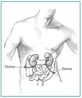 Anatomic drawing of male torso with ureterostomy and inner organs visible.  The small and large intestines are shown in outline.  The kidneys and ureters are displayed in more detail.  The ureters descend from the kidneys to the skin surface, where they form two stomas.