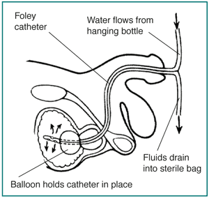 Side view diagram of male urinary tract with Foley catheter in place to drain urine. A balloon near the tip holds the catheter in place.