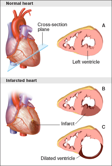 Figure 6.1. Normal vs. Infarcted Heart.  The top panel shows a normal heart, and the bottom panel shows a heart damaged by an infarction, or heart attack.  The left ventricle has a thick muscular wall, shown in cross-section in figure A. After a myocardial infarction, heart muscle cells in the left ventricle are deprived of oxygen and die, indicated by dark-colored section in the ventricle wall of (B), eventually causing the ventricular wall to become thinner, as shown in (C).