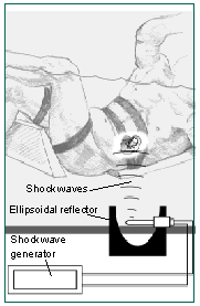 Illustration of extracorporeal shock wave lithotripsy