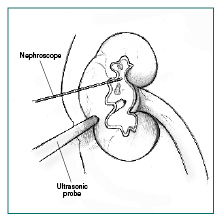Illustration of percutaneous nephrolithotomy.