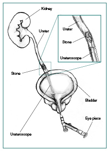 Illustration of ureteroscopic stone removal