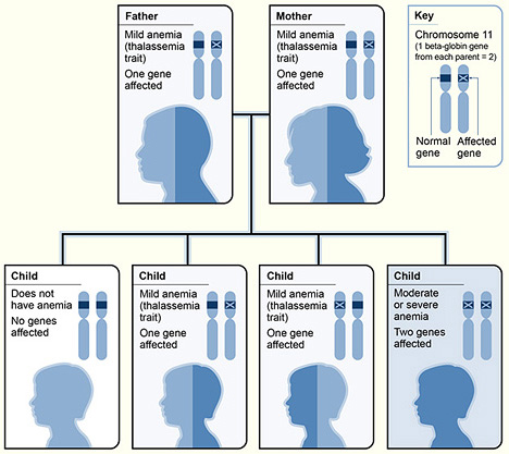 A diagram showing one example of how beta thalassemia is inherited.  The beta globin gene is located on chromosome 11. A child inherits two beta globin genes-one from each parent. In this example, each parent has one altered beta globin gene.