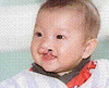 child with cleft lip/palate