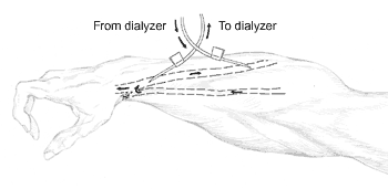 Illustration of an arm with arterial and venous needles.