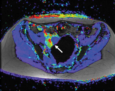 , tumor blood flow 