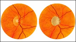 Painting of a normal optic disc and a glaucomatous optic disc