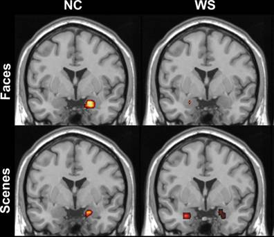 A photo showing abnormal regulation of the amygdala in participants
              with Williams Syndrome (right) compared to controls
              (left). The amygdala activates more for threatening
              scenes (bottom), but less for threatening faces (top)