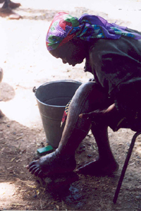 A woman in Nigeria washes her left leg and foot, swollen by lymphatic filariasis; more advanced cases can be very crippling; frequent washing with soap and water helps prevent bacterial superinfection.
