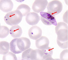 Red blood cells, some of which are infected with Plasmodium falciparum malaria parasites.