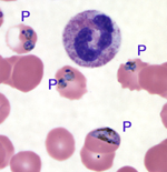 Image from a blood smear from a 48-year old woman who developed Plasmodium falciparum malaria after travel to the Dominican Republic. Examination under the microscope at 1000-fold magnification shows four of the red blood cells infected by parasites (“P”).