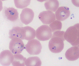 Thin blood smear