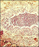 Bronchiolar plugging in neonate with pertussis pneumonia.