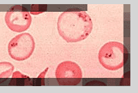 [Sickle Cell Image]
