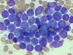 Fluorescence in situ hybridization of leukemic cells from a patient with IKAROS deletion. The IKAROS gene is tagged in green. The red-colored control “probe” shows the normal two signals per cell. The cell nuclei are stained blue.