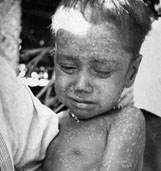 Global eradication of smallpox was achieved