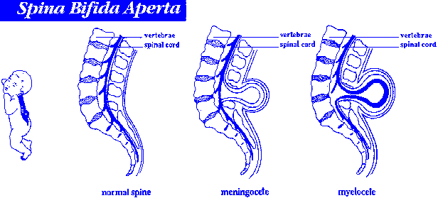Spina Bifida Aperta: image showing normal spine,
 meningocyte, and myelocete