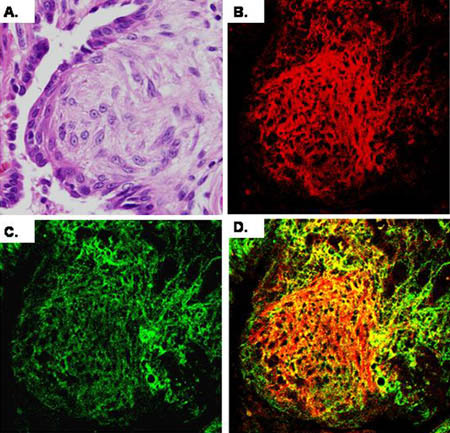 Micrograph of lung cells from a patient with idiopathic pulmonary fibrosis (Panel A).  IαI (Panel B, red) and hyaluronan (Panel C, green) are found throughout the fibroblastic focus, but mostly in the periphery. An image of IαI and hyaluronan co-localization (Panel D, yellow).