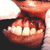 Kaposi sarcoma: oral plaque