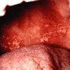 Candidiasis: pseudomembranous