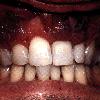 Kaposi sarcoma: occurring in the gingiva