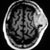 Non-Hodgkin lymphoma: CT scan of head