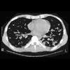 Kaposi sarcoma: chest CT with typical findings