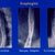 Esophagitis