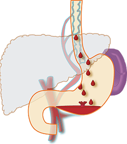 Esophageal Bleed