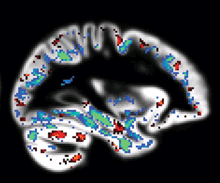 Image of brain with scattered, small areas of color.