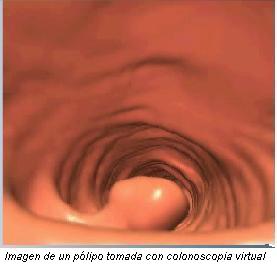 Imagen de un pólipo tomada con colonoscopia virtual