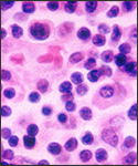 Histopathology of a lymph node in a case of Typhoid Fever.