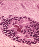 This micrograph depicts the histopathologic changes associated with rabies encephalitis prepared using an H&E stain.