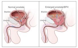 Two-panel drawing shows normal male reproductive and urinary anatomy and benign prostatic hyperplasia (BPH). Panel on the left shows the normal prostate and flow of urine from the bladder through the urethra. Panel on the right shows an enlarged prostate pressing on the bladder and urethra, blocking the flow of urine.