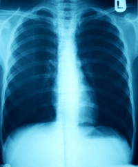 Lung Diseases