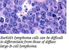 Burkitt's lymphoma cells can be difficult to differentiate from those of diffuse large-B-cell lymphoma.