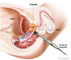 Biopsia transrectal; el dibujo muestra una vista lateral de la próstata, la vejiga y el recto. El dibujo también muestra una sonda de ecografía con una aguja que se inserta en el recto para extraer muestras de tejido de la próstata.