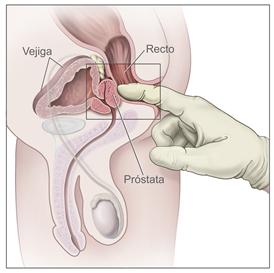 Examen rectal digital; el dibujo muestra una vista lateral de la anatomía reproductora y urinaria masculina la cual incluye la próstata, el recto y la vejiga; también muestra un dedo dentro de un guante lubricado que se inserta en el recto para palpar la próstata.