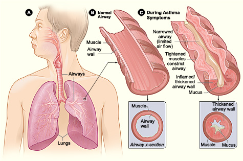 Figure A shows the location of the lungs and airways in the body. Figure B shows a cross-section of a normal airway. Figure C shows a cross-section of an airway during asthma symptoms.