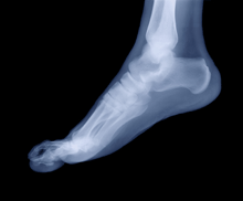 an x-ray image of a human foot.