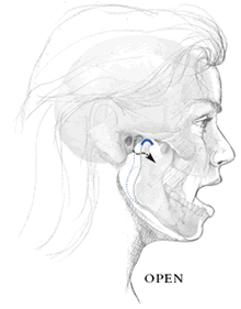 Profile of open mouth showing condyle gliding along the joint socket of the temporal bone