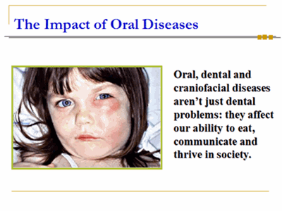 The Impact of Oral Diseases: Oral, dental and craniofacial diseases aren’t just dental problems: they affect our ability to eat, communicate and thrive in society.