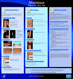 Image: Mantoux Tuberculin Skin Test Wall Chart