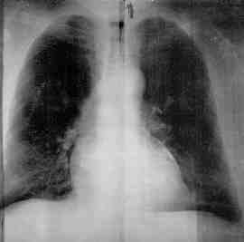 Chest X-ray of Libby Resident