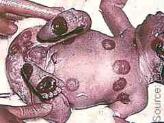 Fetal vaccinia in a child born in the 28th week of gestation