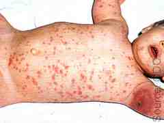 History unknown, extensive generalized vaccinia lesions