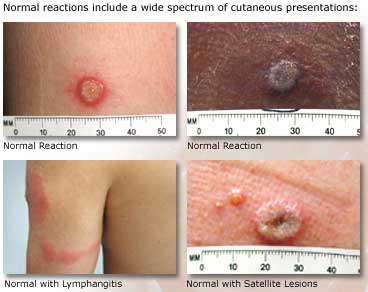 Normal Reactions include a wide spectrum of cutaneous presentations: (click image below)