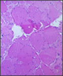 A photomicrograph of skeletal muscle tissue revealing myotonic dystrophic changes as a result of Polio Type III.
